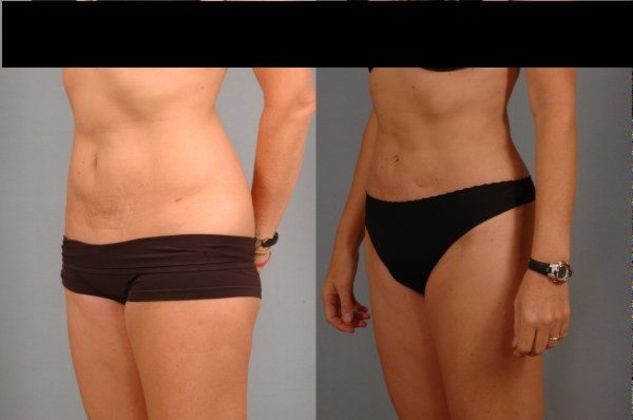 before and after liposuction