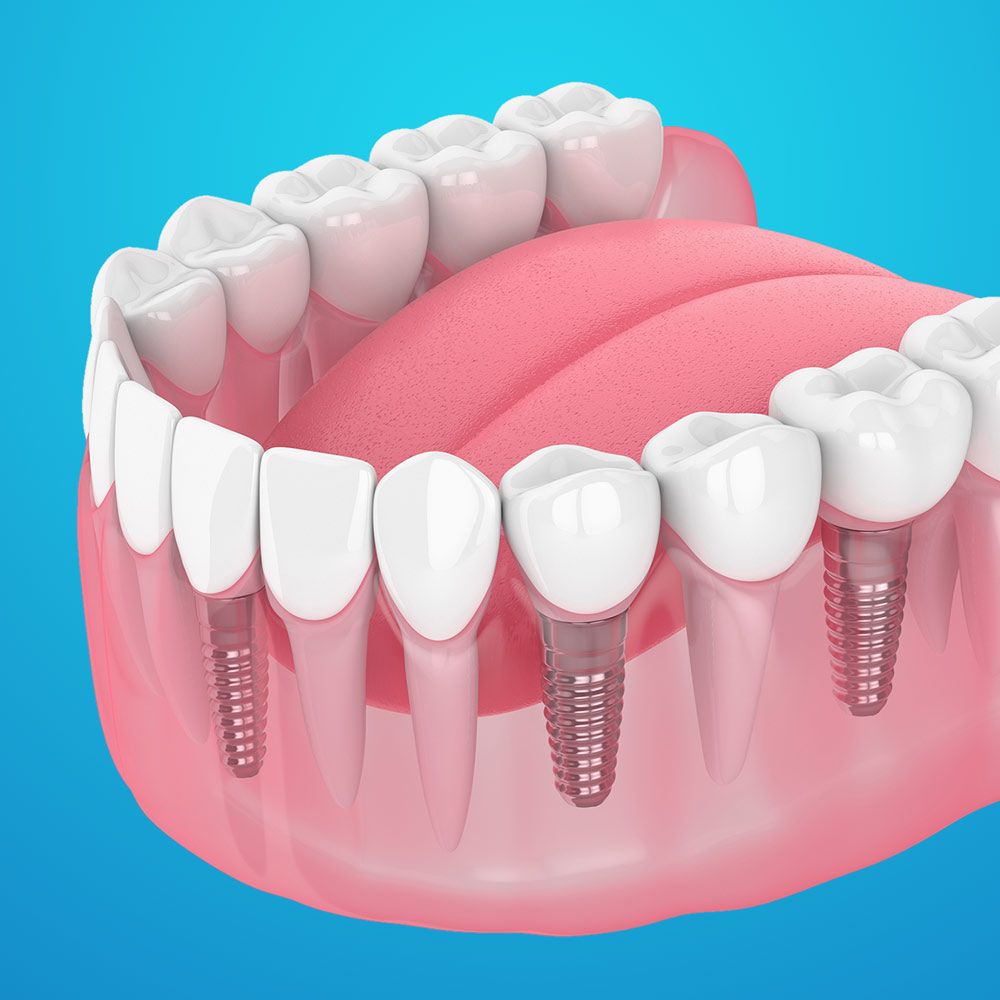 dental implants in a jawbone