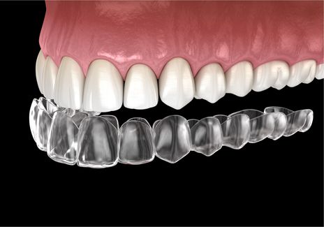 suresmile clear aligners (orthodontics)