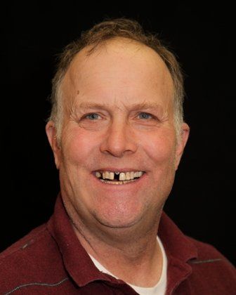 before full mouth reconstruction