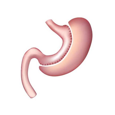 sleeve gastrectomy