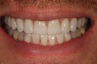 Bucks County Man's straight, white teeth from porcelain veneers