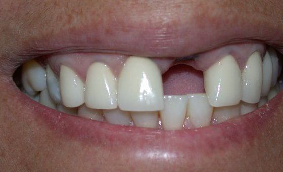 Before dental implant photo