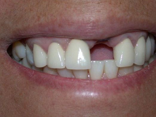 Before Dental Implants photo