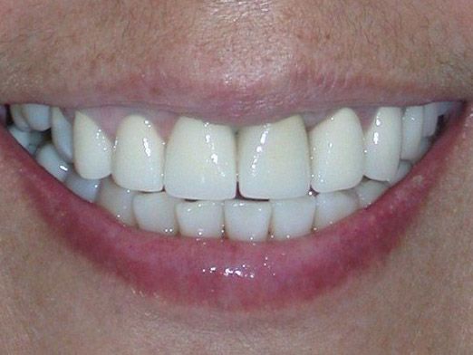 After dental implants photo