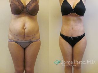 dog ear after tummy tuck dog ear after tummy tuck
