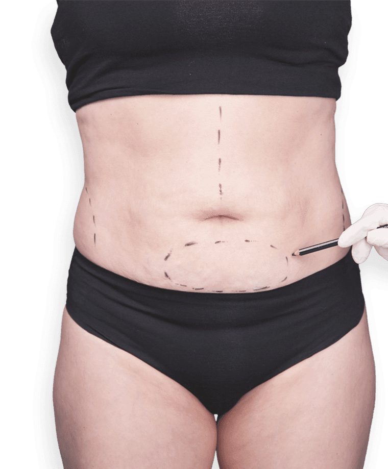 Woman's torso with tummy tuck incisions marked on skin