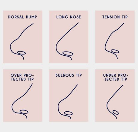 Cosmetic Nasal Imperfections