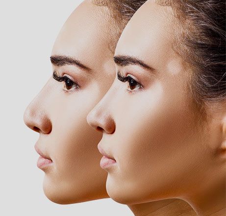 Rhinoplasty