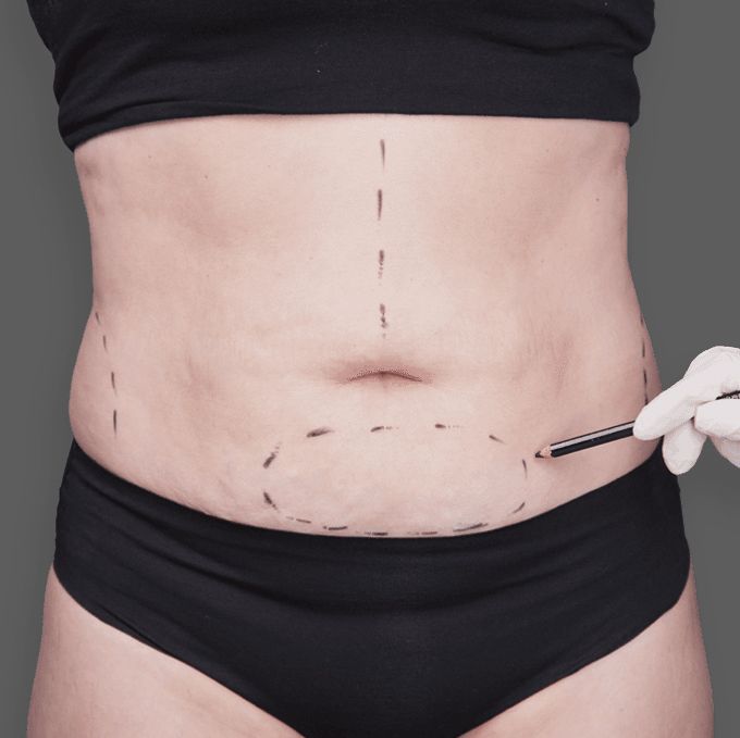 Woman's torso with tummy tuck incisions marked on skin