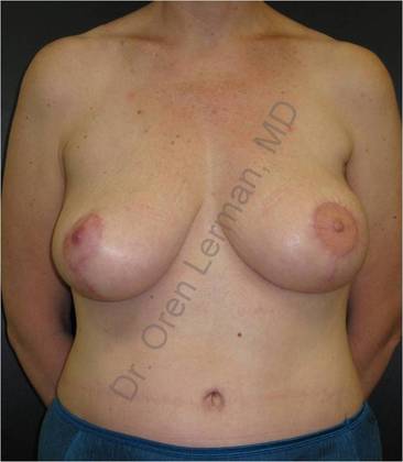 After breast reconstruction
