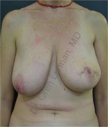 Before breast reconstruction