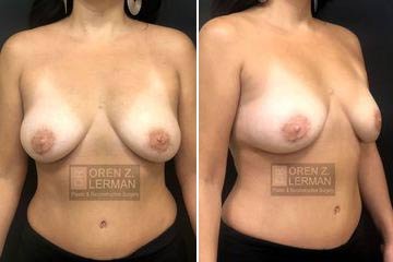 After breast reconstruction