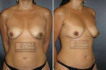 Before breast reconstruction