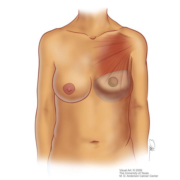 Implant Reconstruction