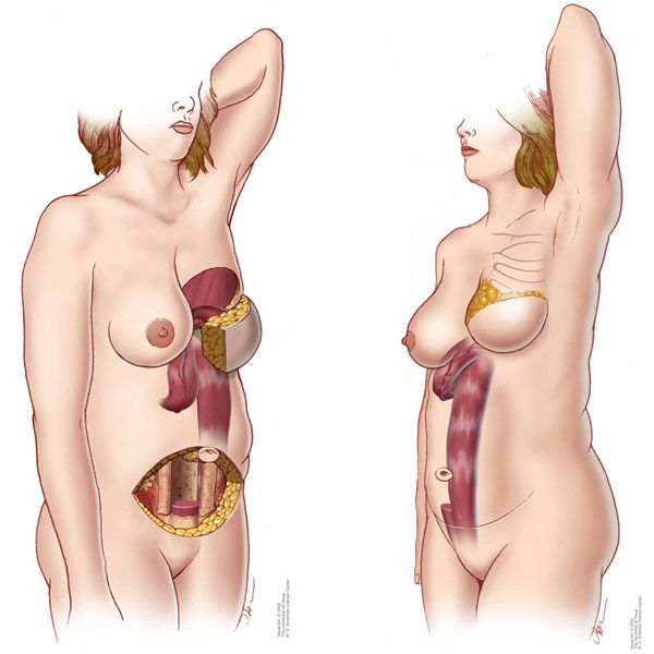 Tissue Flap Reconstruction