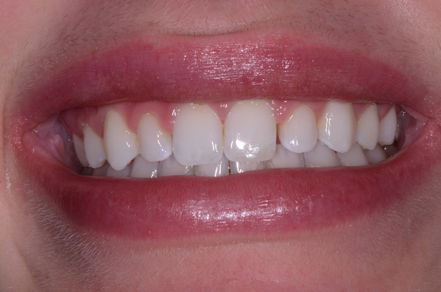 before porcelain veneers