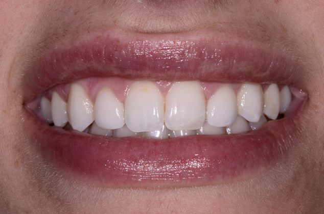 After porcelain veneers