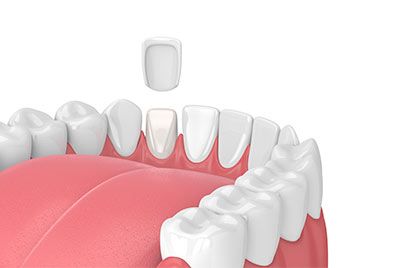Veneers illustration
