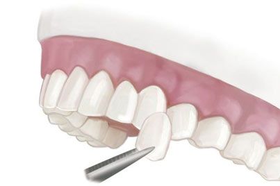 Veneers illustration
