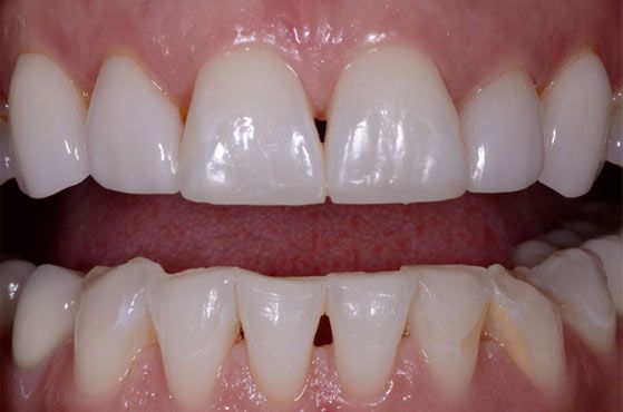 after dental crowns
