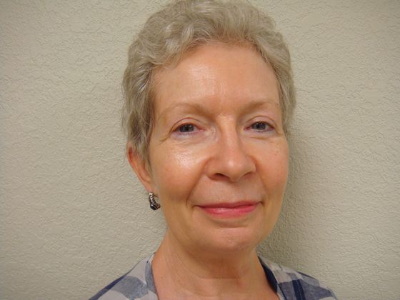 Dr. Stuart Baker's patient after an eye lift