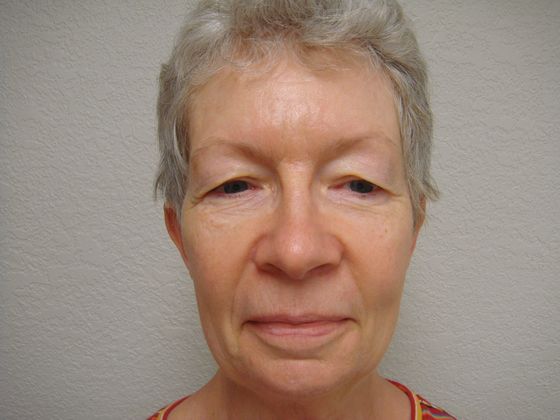 Dr. Stuart Baker's patient before an eye lift