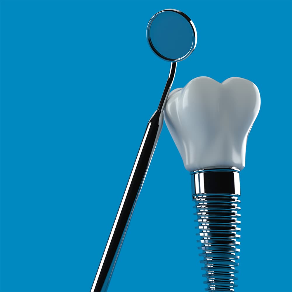 An illustration of dental implants