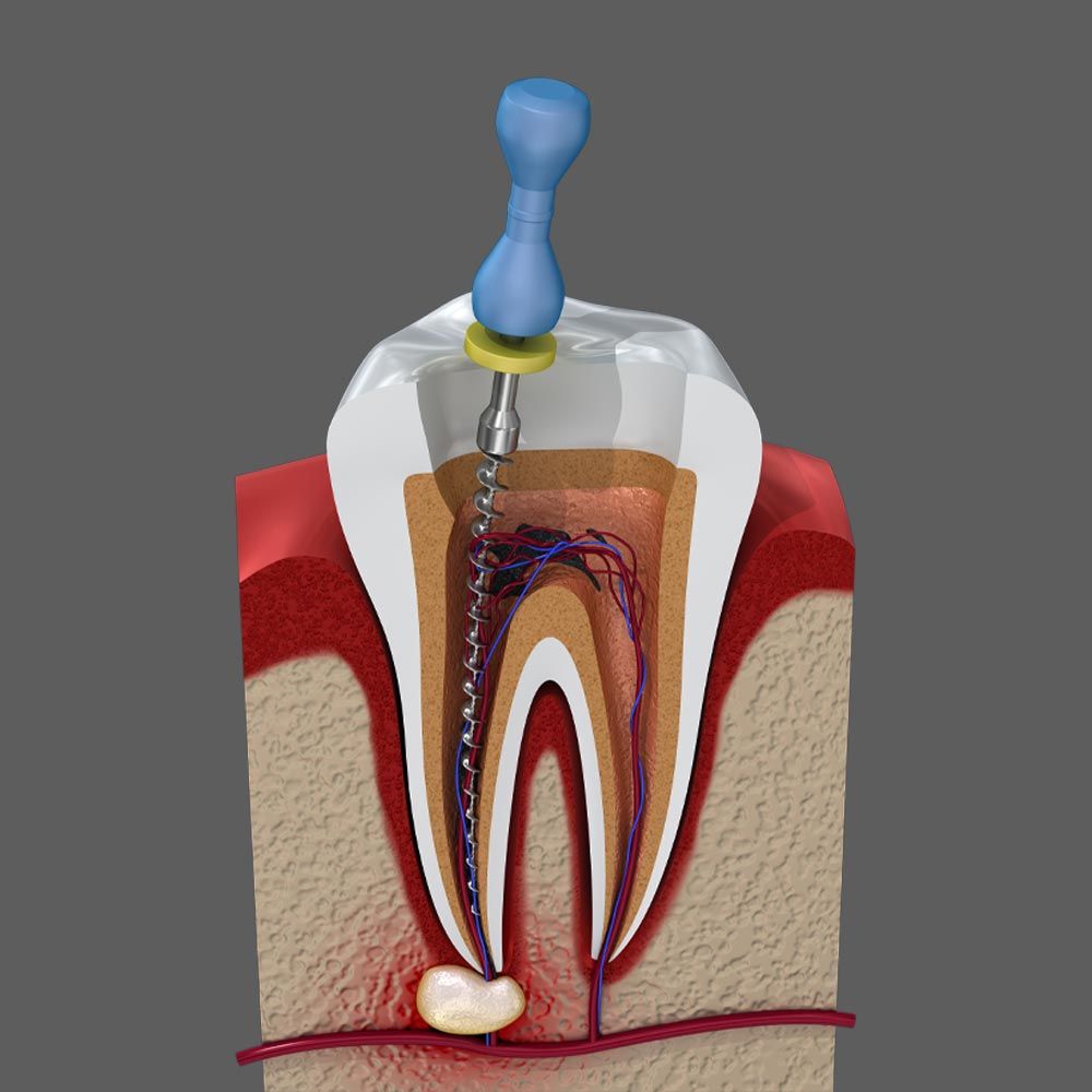 Root Canal Model