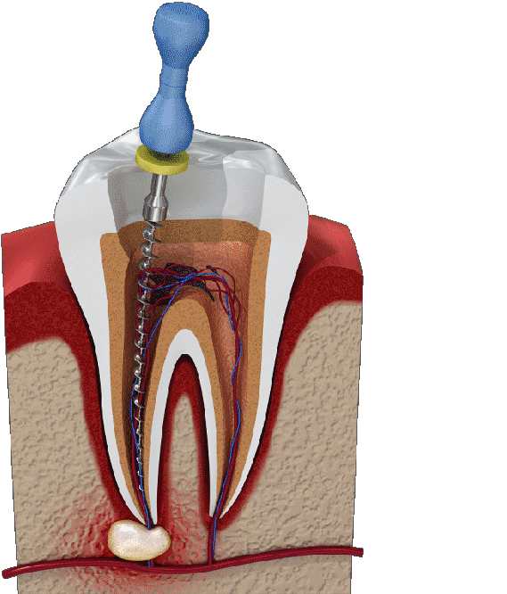 Root Canal Model