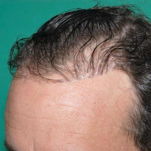 Male hairline