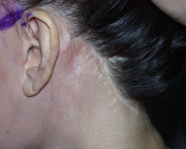 Facelift scar at hairline