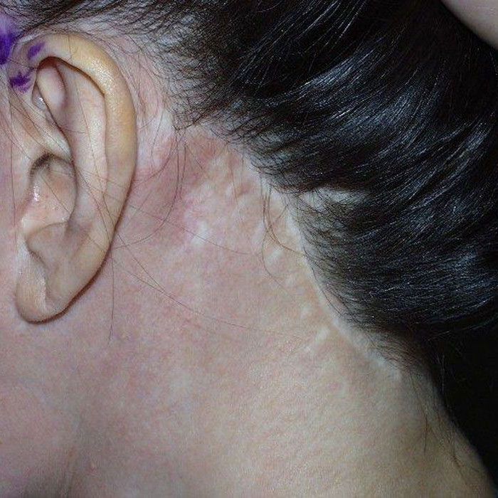 Scar on woman's hairline