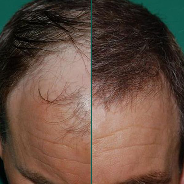 Hairline before and after surgery