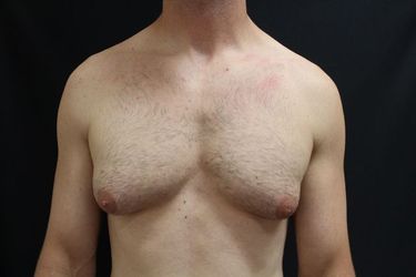 Before gynecomastia treatment