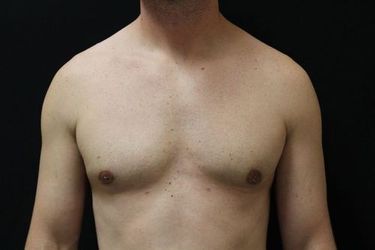 After gynecomastia treatment