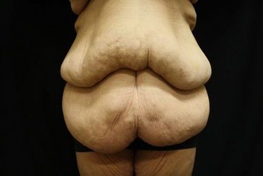 Before body lift