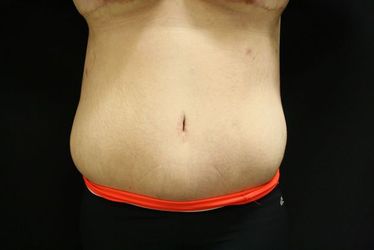 After body lift