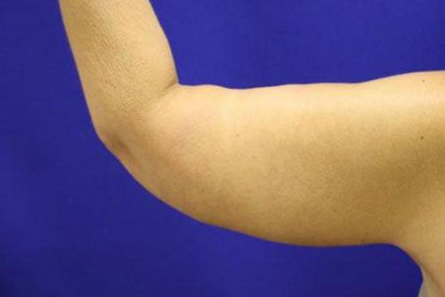 Before arm lift