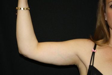 After arm lift