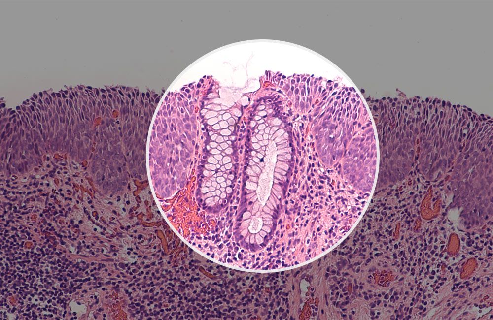 Is Dysplasia Precancerous | Cervical Dysplasia: Causes, Symptoms ...