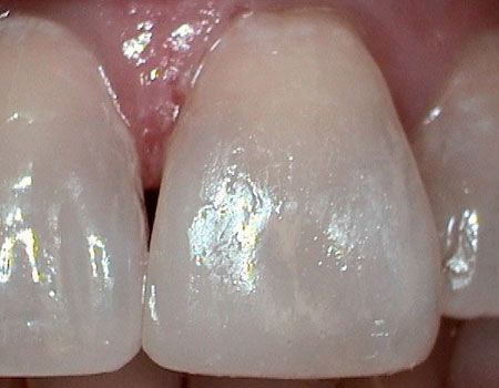 Dental bonding after photo