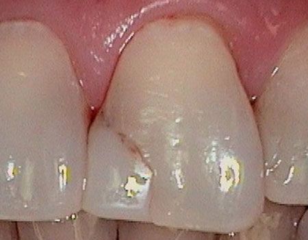 Before dental bonding photo