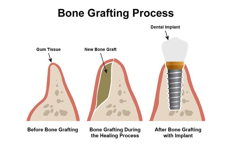 dental bone grafting