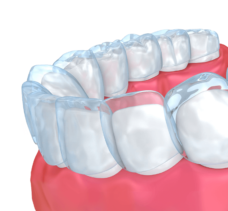 Clear aligners covering a lower arch of teeth