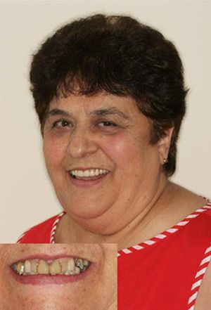 Before and After Full Mouth Reconstruction