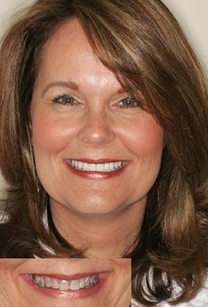 Before and After Smile Makeover