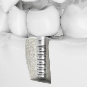 implant-supported crown