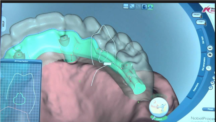 All on Four titanium Prosthesis design