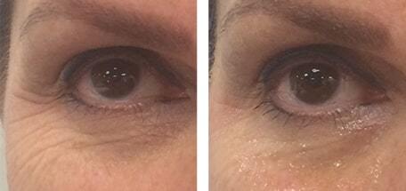 female eyes before and after 1